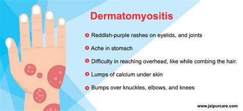 Myositis Causes, Symptoms, Treatment in Jaipur | Dr. Bhupendra Vaishnav