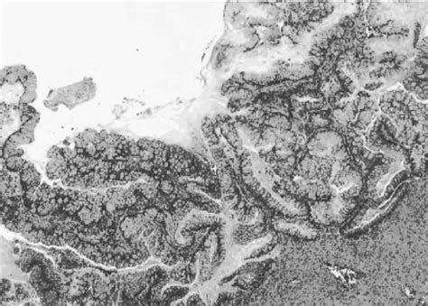 Preoperative sample biopsy photograph, 4X. This representative section ...