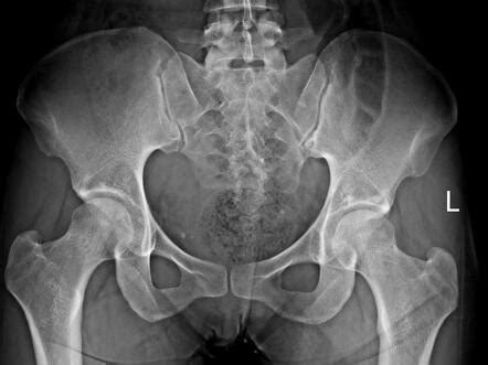 Sacral fracture | Radiology Case | Radiopaedia.org