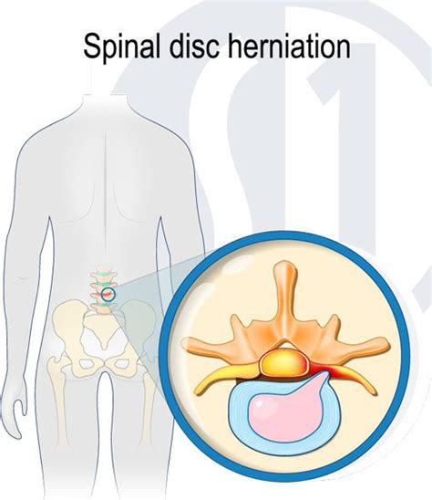 Disc Protrusion Treatment at Spine One | Denver Spine Pain Specialists