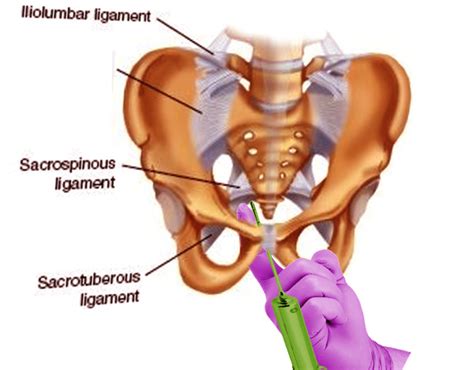 Bilateral Pudendal Nerve Block