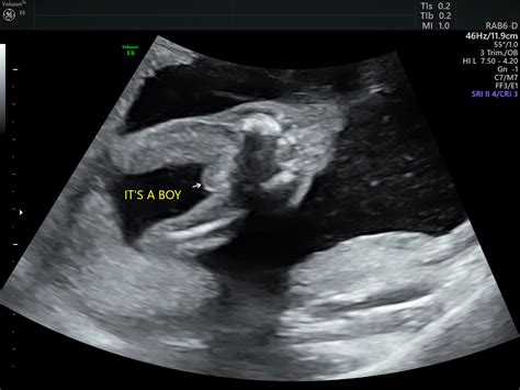 Ultrasound Pictures Of Baby Boy 18 Weeks - Infoupdate.org