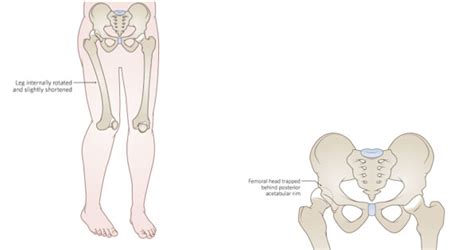 Clinical Practice Guidelines : Hip dislocation - Emergency Department