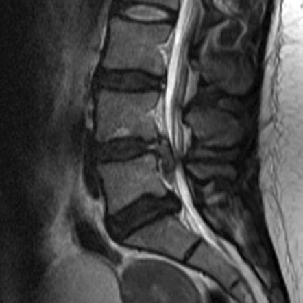 Disc extrusion | Radiology Reference Article | Radiopaedia.org