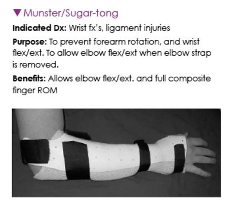 Sugar Tong Splint #surgery #hand #surgery | Ocupational therapy, Occupational therapy schools ...