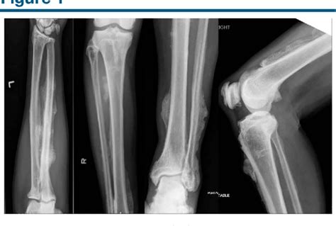 Figure 1 from Rare Case of Diffuse Skeletal Fluorosis Due to Inhalant ...