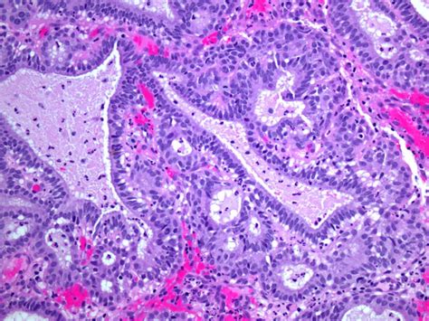 Epithelioid hemangioendothelioma – Blog | PathologyOutlines.com