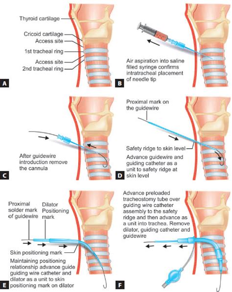 Tracheostomy Procedure Steps