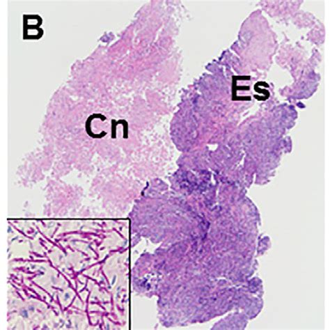 Esophageal Candidiasis