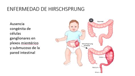 Ileal Atresia : Here, we present a case of fetus with multiple ileal atresia.