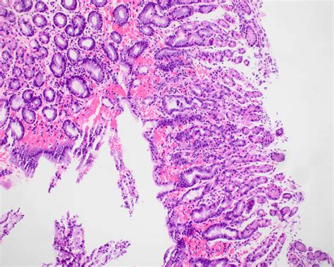 Portal Hypertension Histology