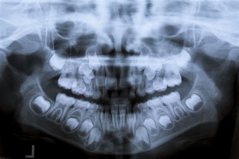 Why are OPG X-rays so essential for your oral health? - Healthy Smile Dental