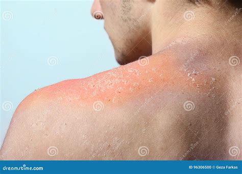 Skin peeling after sunburn stock photo. Image of epidermis - 96306500