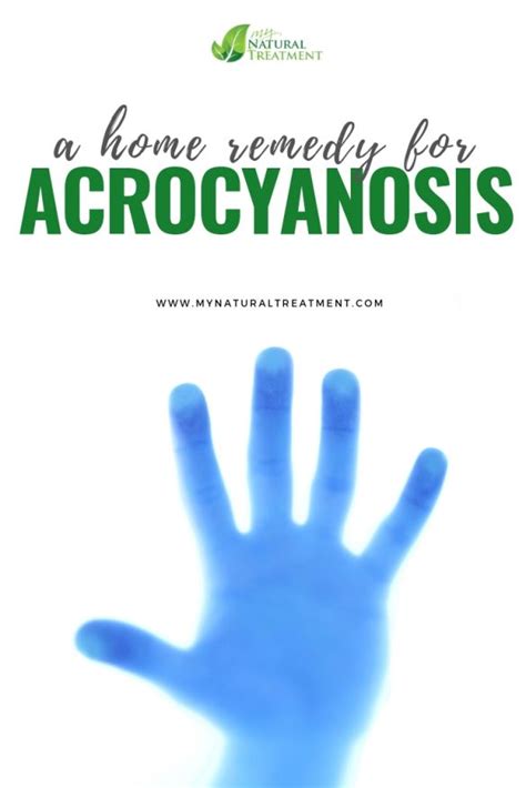 Complete Home Remedy for Acrocyanosis with 1 Herb