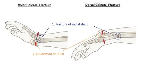 Galeazzi fracture orthobullets - stormbangkok