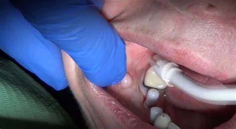 Removal Oral Fibroma with Electrosurge. | Dental surgery, Dentistry, Dental