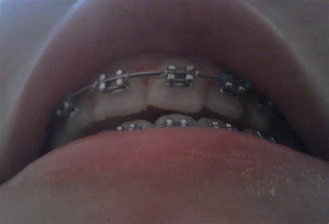 Maria's Blog: Rubber Bands - Teeth update (28/2/2012)