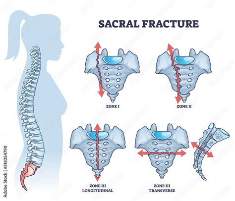 Sacral fracture with backbone skeletal trauma or injury types outline diagram. Labeled ...