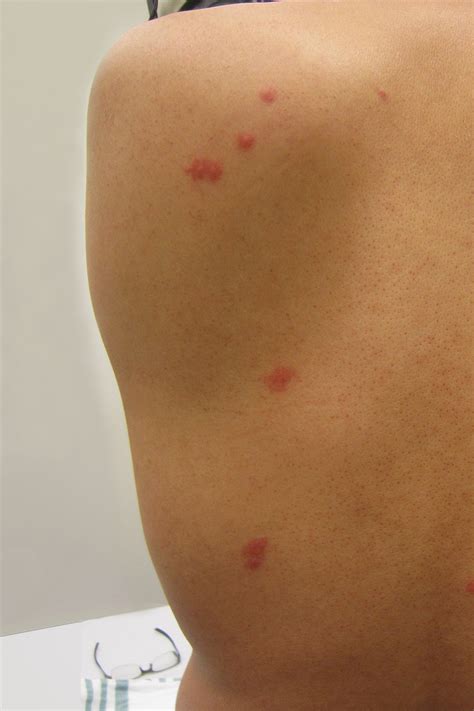 Bed Bug Bites Treatment In Philadelphia, PA 267-282-0022