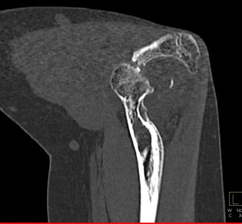 Prior Fracture Dislocation of the Elbow with Periosteal Reaction - Musculoskeletal Case Studies ...