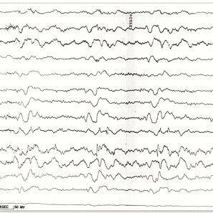 EEG in various stages of SSPE. A: The background activity is... | Download Scientific Diagram