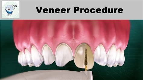 Dental Veneers Procedure Step by step - YouTube