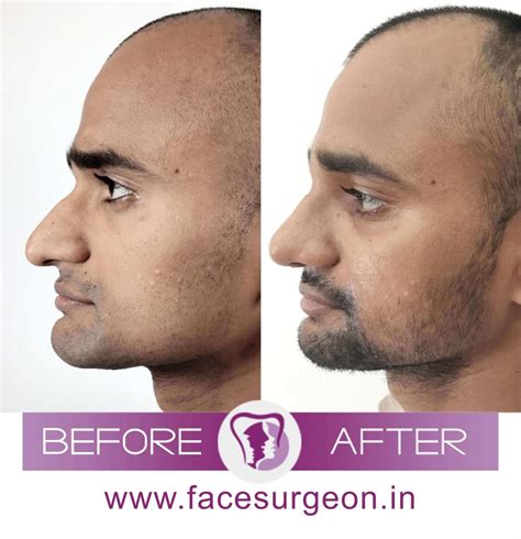 Nose Surgery in India | How Ethnicity Determine the Surgical Procedure