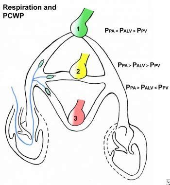 What are the vertical lung zones relevant to pulmonary artery ...