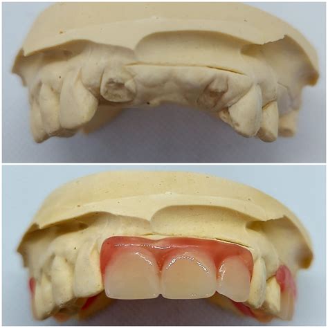 Get Flexible Partial Dentures Online | Dental Lab Direct