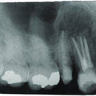 (A) A preoperative radiograph of a maxillary canine with a... | Download Scientific Diagram