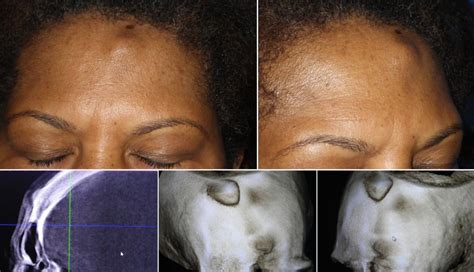 Forehead Osteomas and Their Treatment