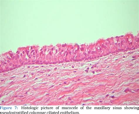 Figure 7 from Pathology Differential diagnosis of antral pseudocyst ...