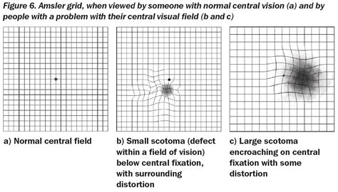 Glaucoma Vision Test