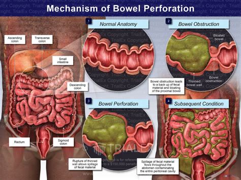 Mechanism of Bowel Perforation African American Male - TrialQuest...