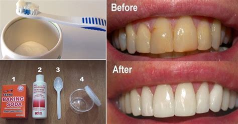 How To Get Rid Of Plaque And Gum Disease Without Expensive Treatmens ...