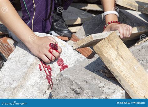 Hand injury stock image. Image of nail, human, health - 37523557