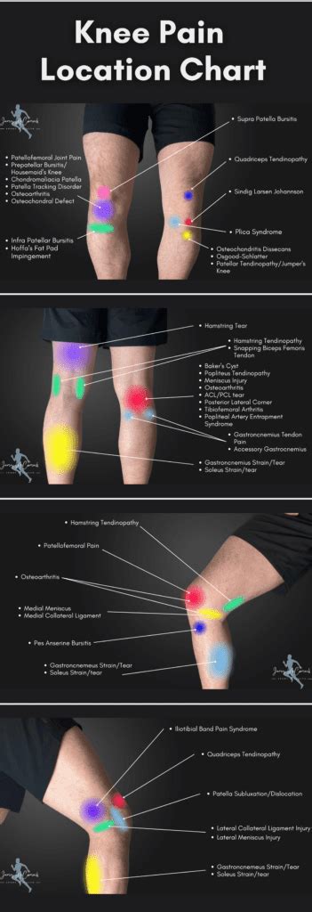 Knee Pain Location Chart | Learn the Pain Location of Knee Injuries