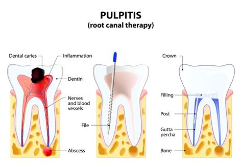 Root Canal Therapy - Smile Center Villa Rica