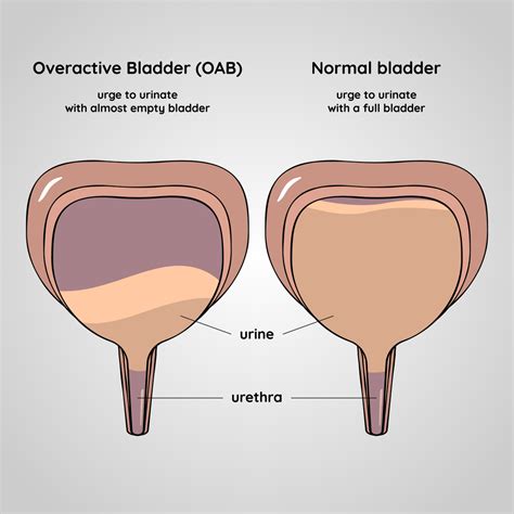 What Do Bladder Stones Look Like