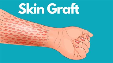 Skin Graft Medical Term at Bernice Lujan blog