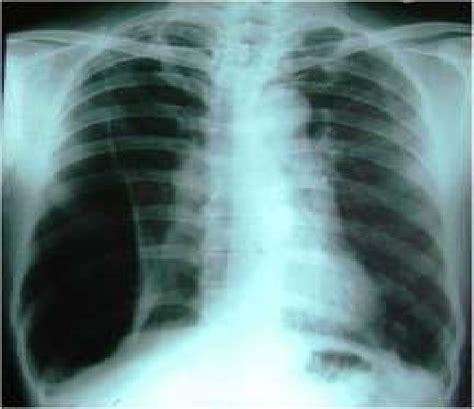 Chest x-ray PA view What is the diagnosis from the Chest X-ray ? A ...