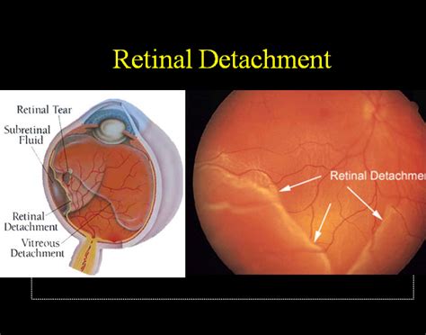 Detached retina symptoms causes - pathmine