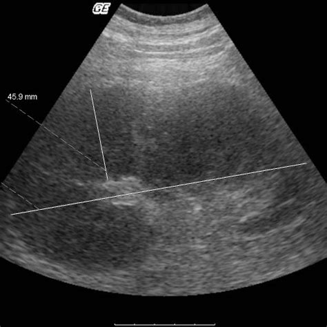 Ultrasound scan demonstrating enlarged kidney with thickened cortex. | Download Scientific Diagram