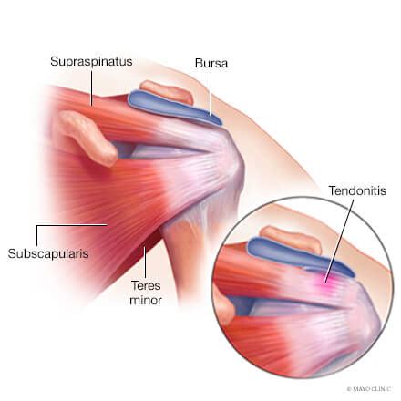 limit bias Generosity can you tear both rotator cuffs receiving lung ...