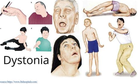 Dystonia-Symptoms, Causes, and treatments.| Dr. Gurneet Sawhney