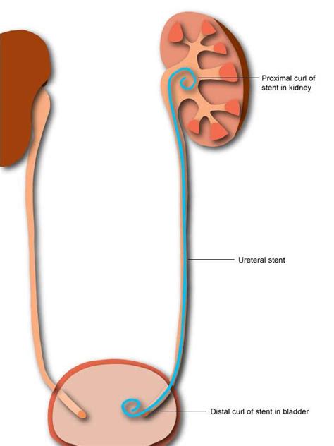 How Is A Kidney Stone Removed From The Ureter - HealthyKidneyClub.com