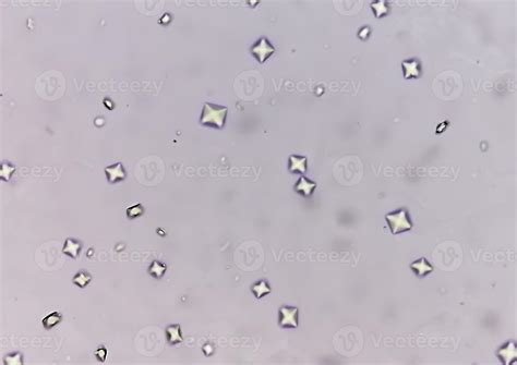 Calcium oxalate crystal from urine sediment. 8930974 Stock Photo at ...