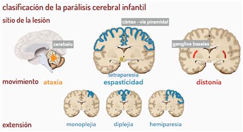 Tipos de parálisis cerebral infantil - neuronas en crecimiento