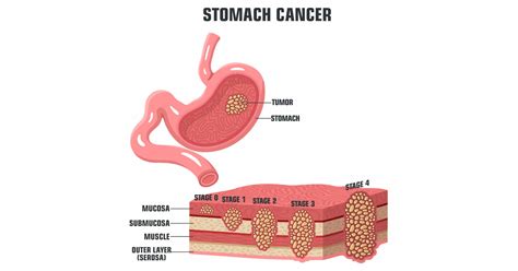 Stomach Cancer: Symptoms, Types, Stages, Prevention and Treatment