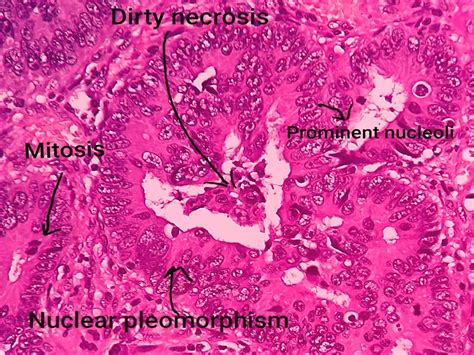 Pathology of Adenocarcinoma-Colon - Pathology Made Simple